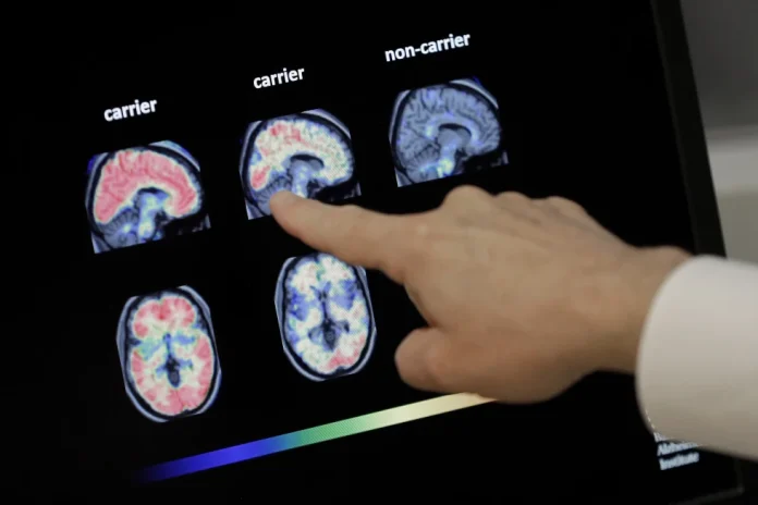 Vivir más tiempo podría aumentar el riesgo de demencia, pero hay formas de reducirlo